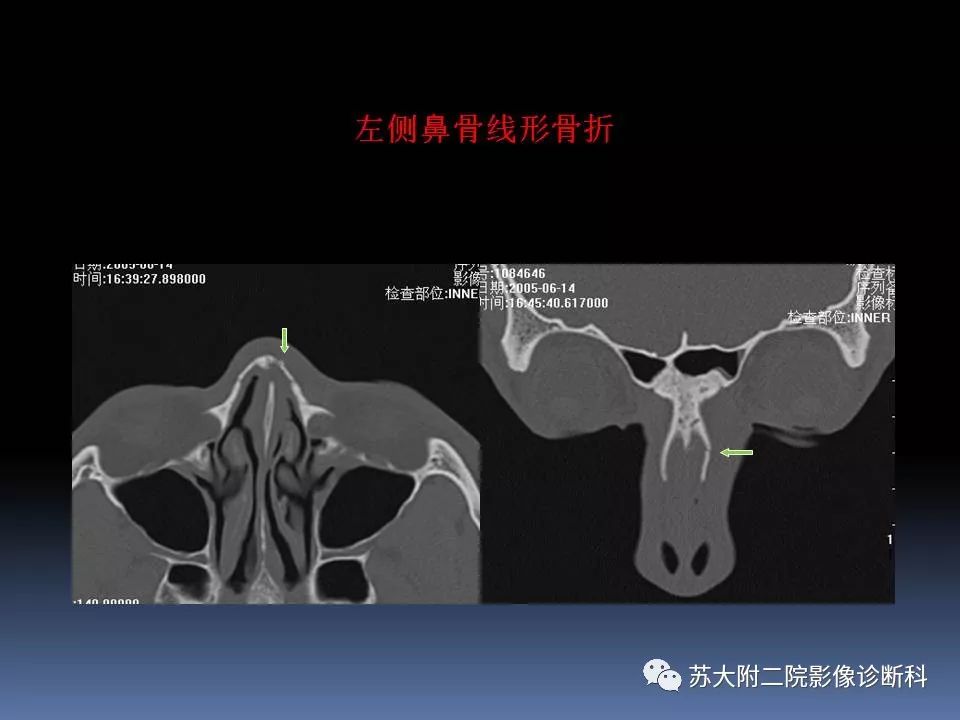 【PPT】鼻骨骨折影像诊断误区-25