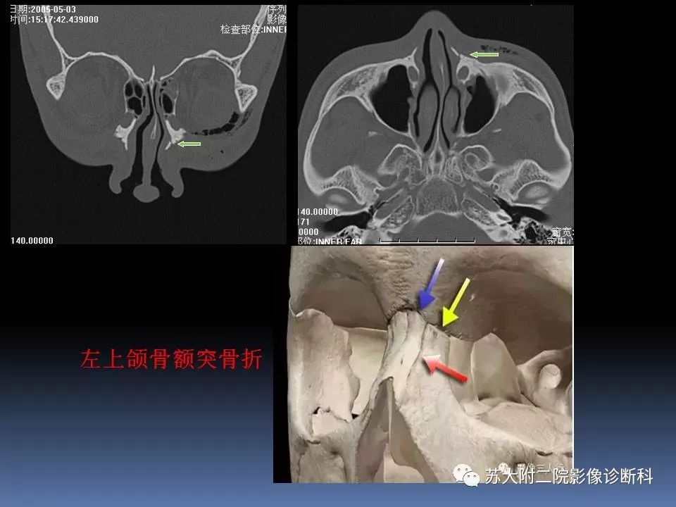 【PPT】鼻骨骨折影像诊断误区-27