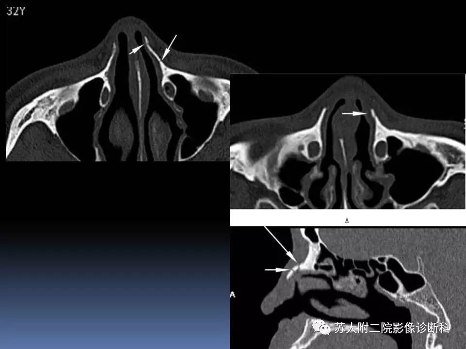 【PPT】鼻骨骨折影像诊断误区-28