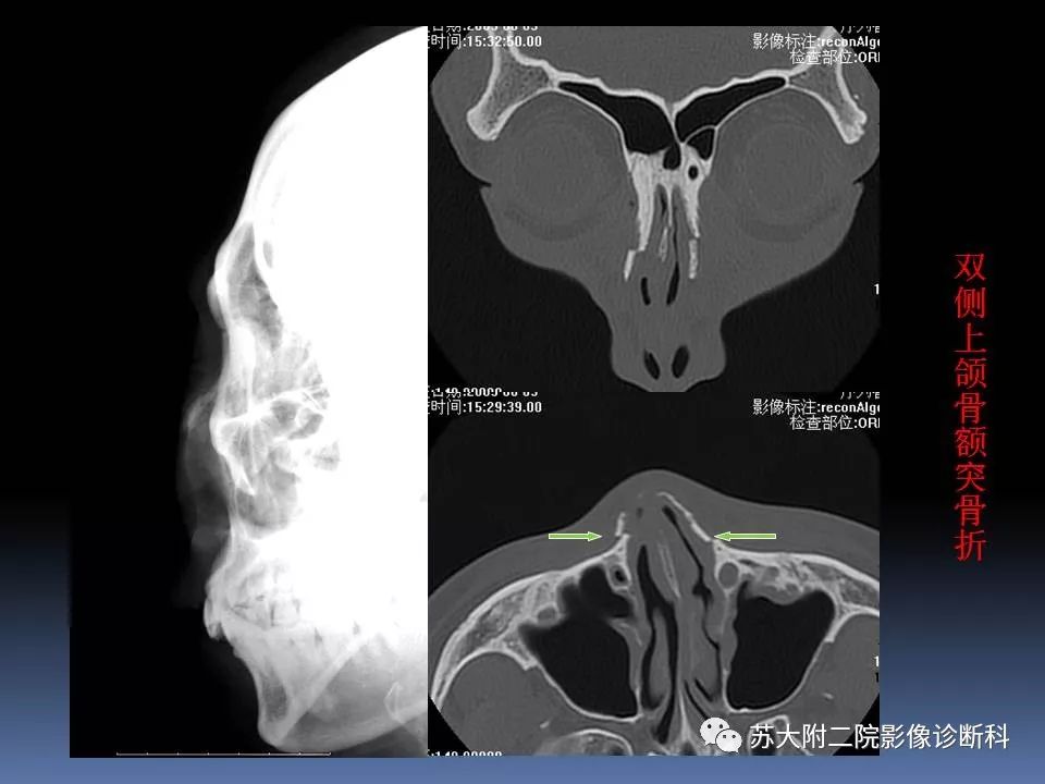 【PPT】鼻骨骨折影像诊断误区-29