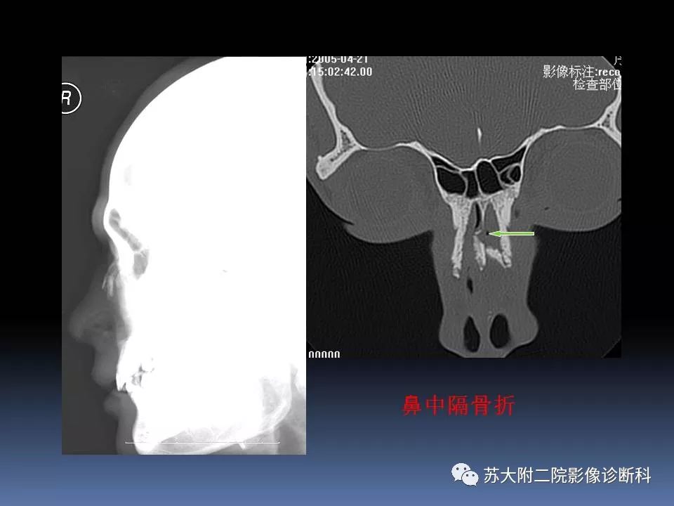 【PPT】鼻骨骨折影像诊断误区-30