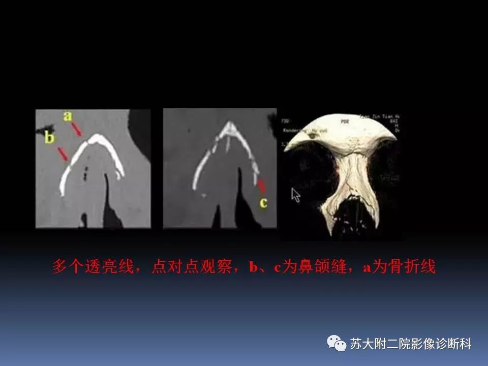 【PPT】鼻骨骨折影像诊断误区-31
