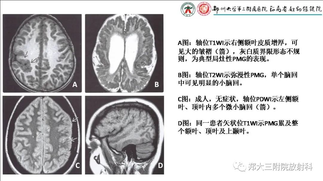 【PPT】多小脑回畸形的影像表现-9