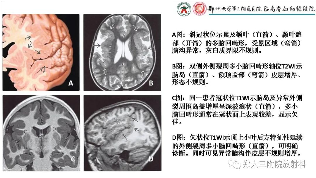 【PPT】多小脑回畸形的影像表现-8