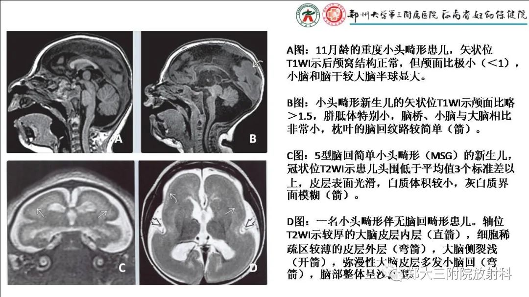 【PPT】多小脑回畸形的影像表现-20