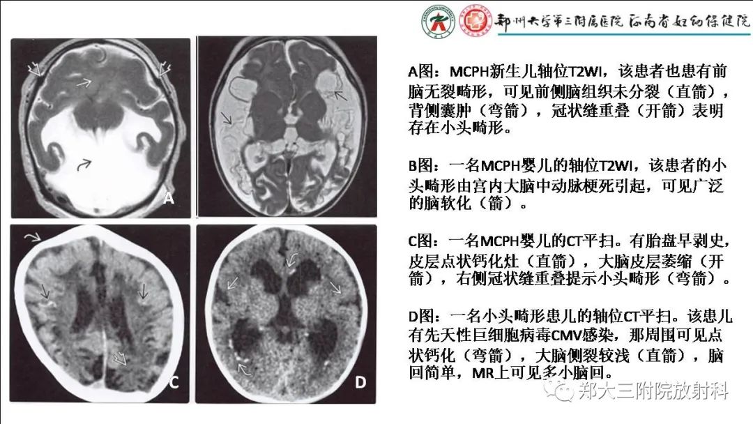 【PPT】多小脑回畸形的影像表现-21