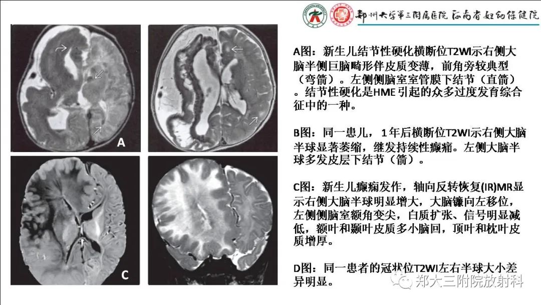 【PPT】多小脑回畸形的影像表现-24
