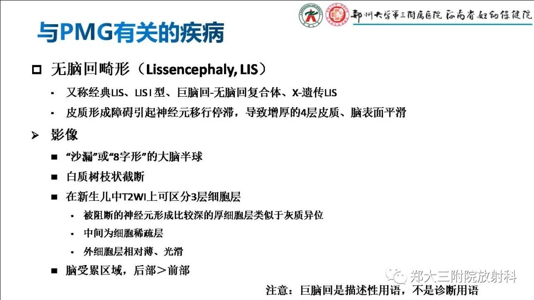 【PPT】多小脑回畸形的影像表现-28