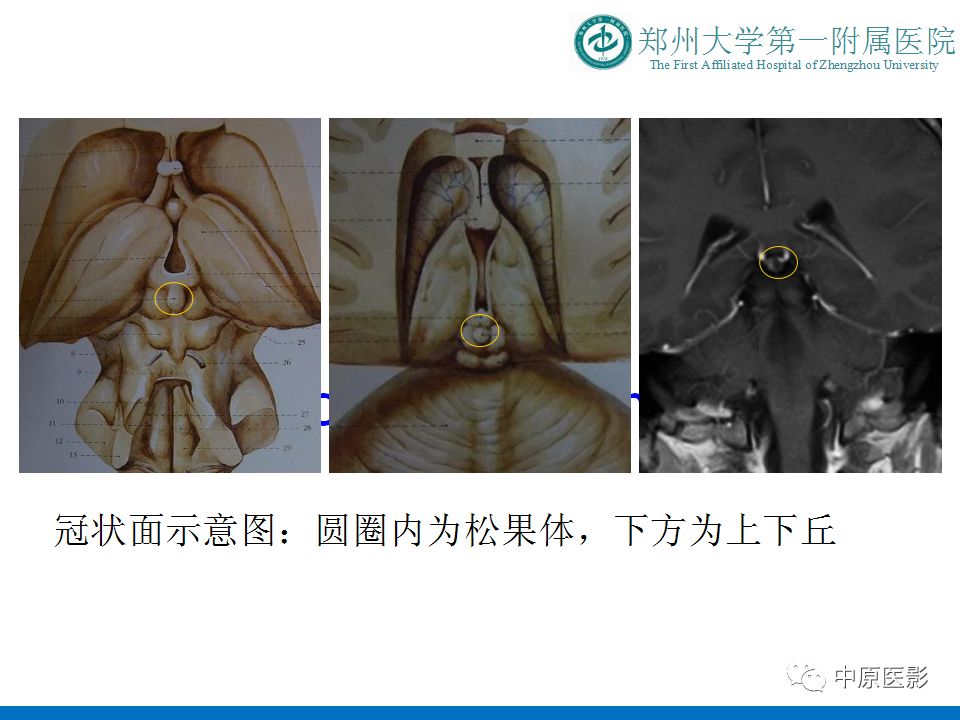 【PPT】松果体区肿瘤的MRI影像分析-4