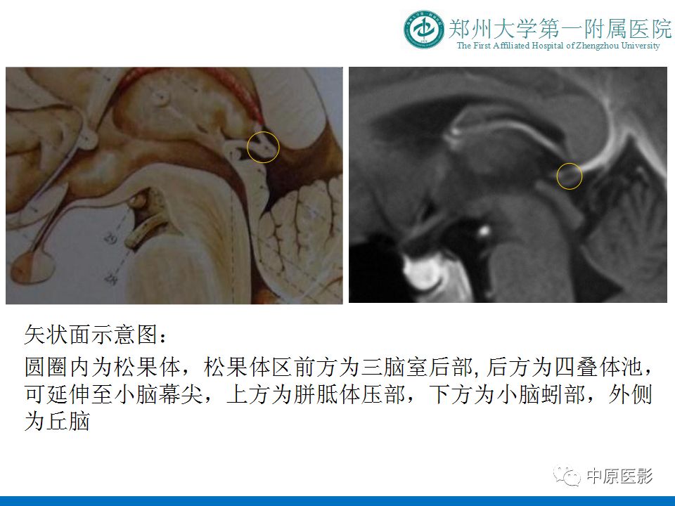 【PPT】松果体区肿瘤的MRI影像分析-5
