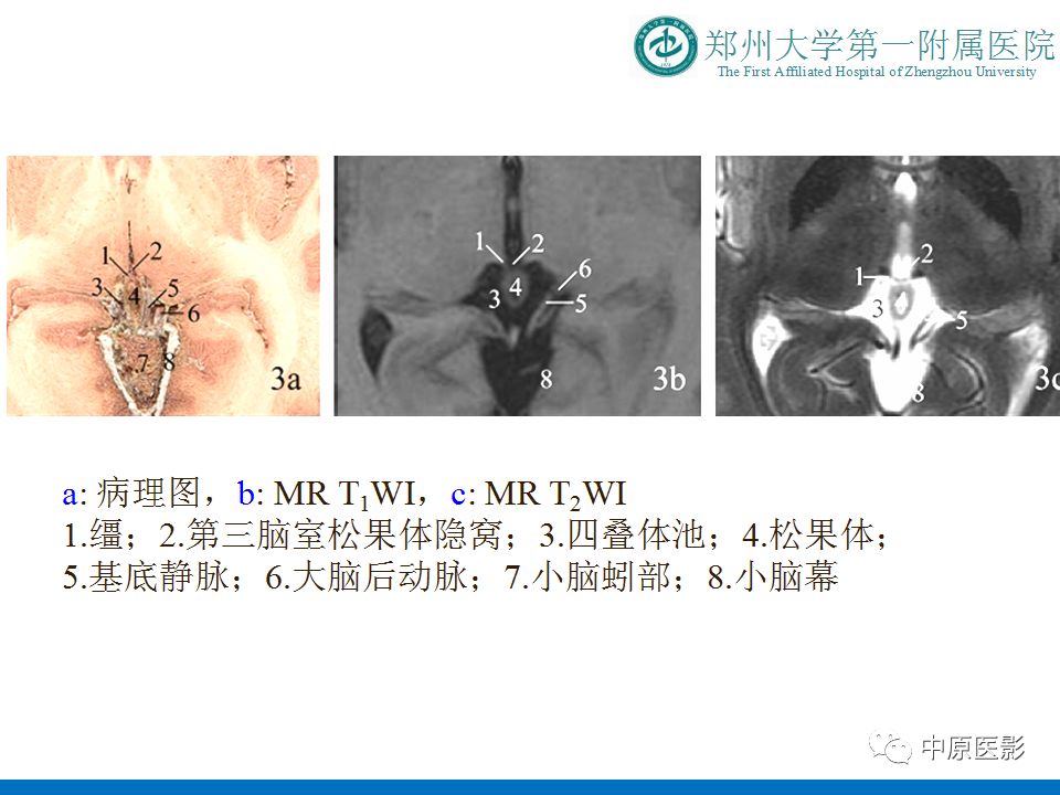 【PPT】松果体区肿瘤的MRI影像分析-7