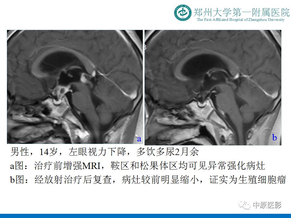 【PPT】松果体区肿瘤的MRI影像分析-13