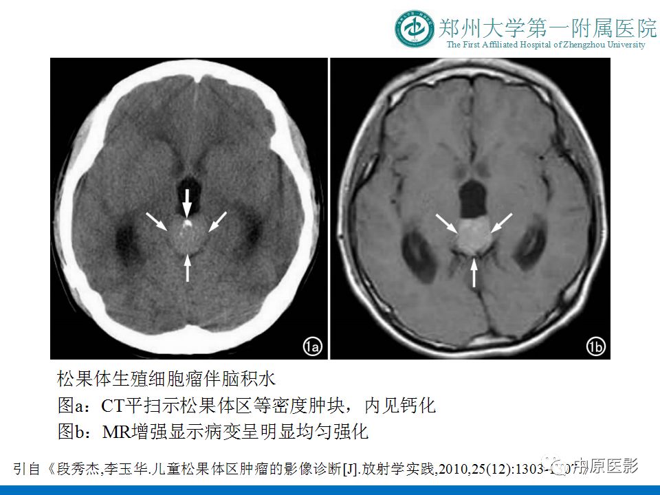 【PPT】松果体区肿瘤的MRI影像分析-12