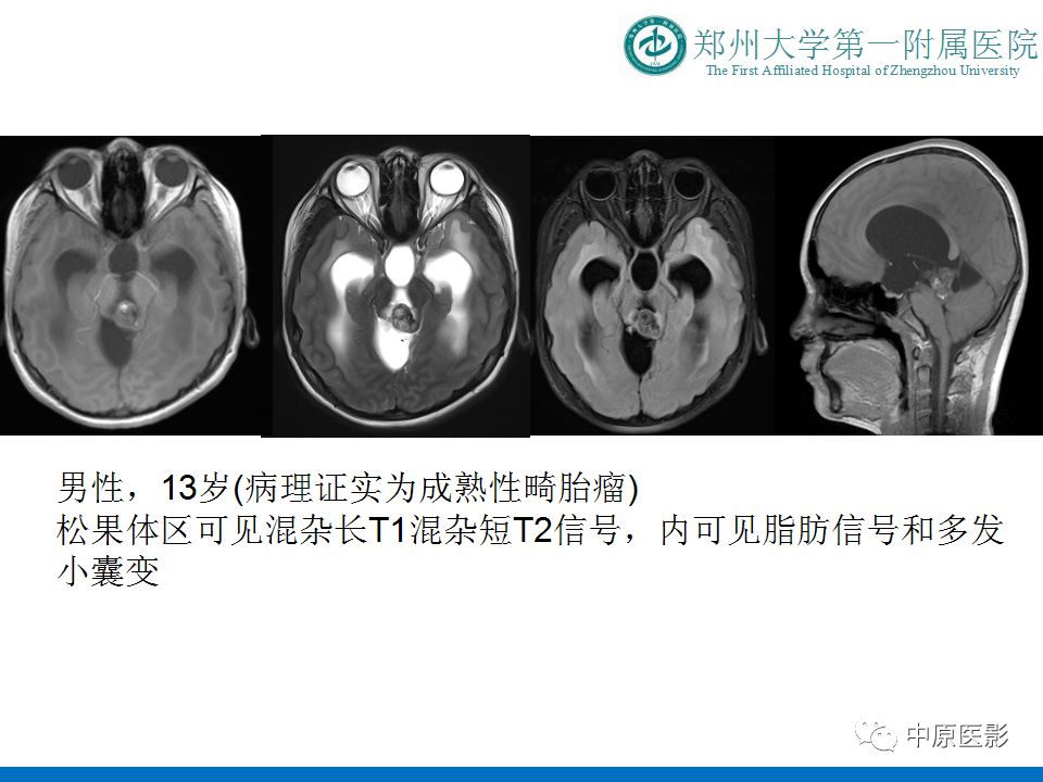 【PPT】松果体区肿瘤的MRI影像分析-16