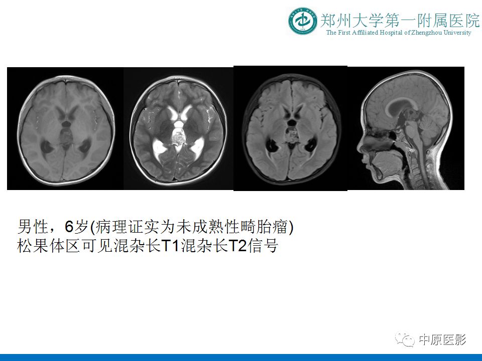 【PPT】松果体区肿瘤的MRI影像分析-19
