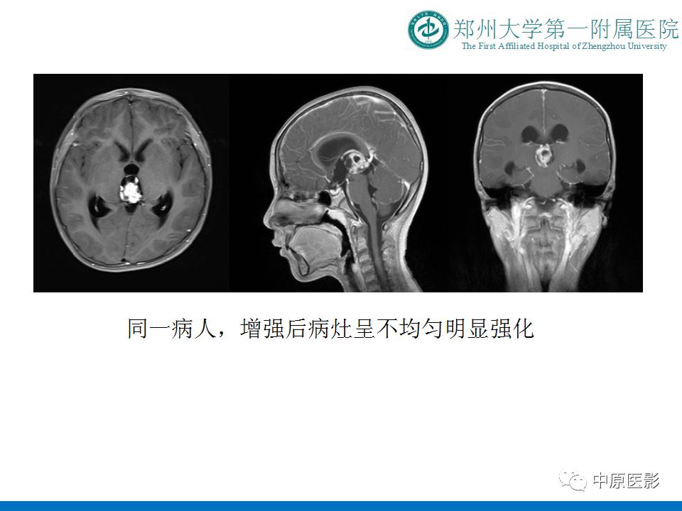 【PPT】松果体区肿瘤的MRI影像分析-20