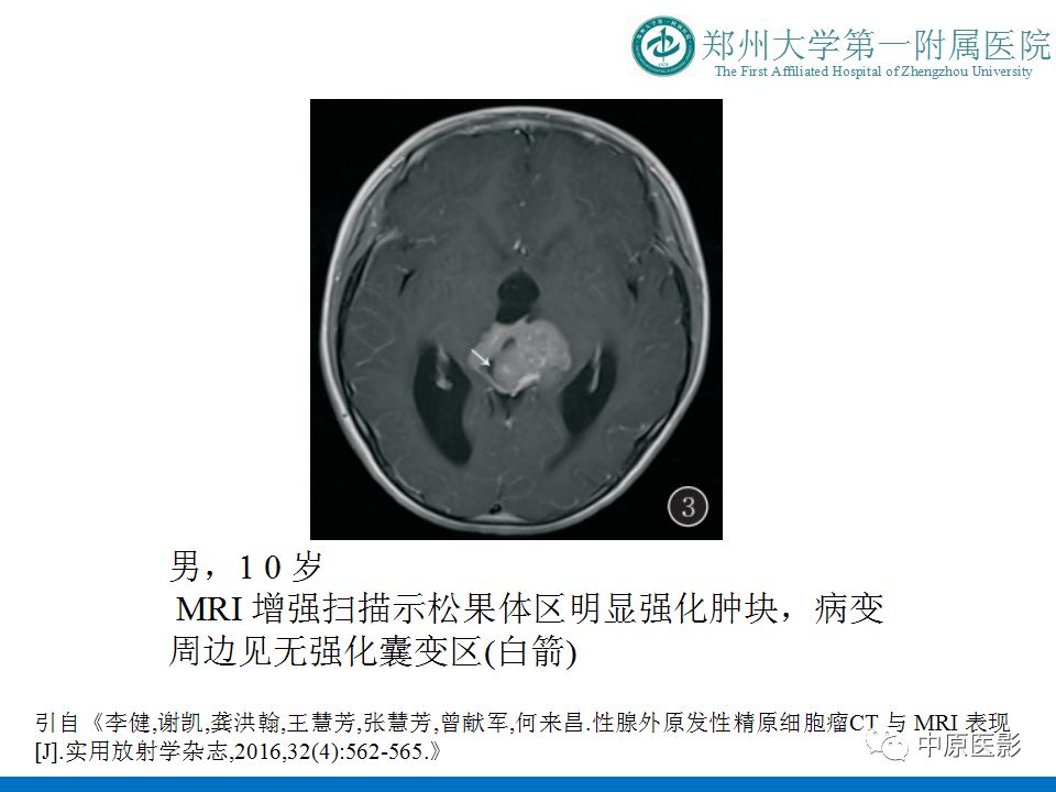 【PPT】松果体区肿瘤的MRI影像分析-24
