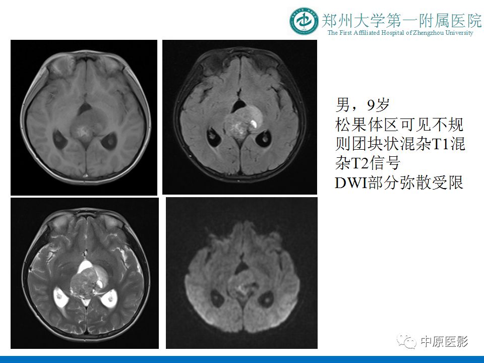 【PPT】松果体区肿瘤的MRI影像分析-26