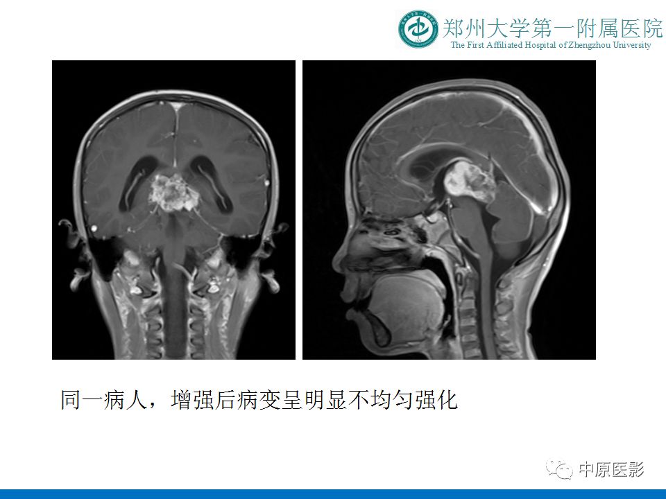 【PPT】松果体区肿瘤的MRI影像分析-27