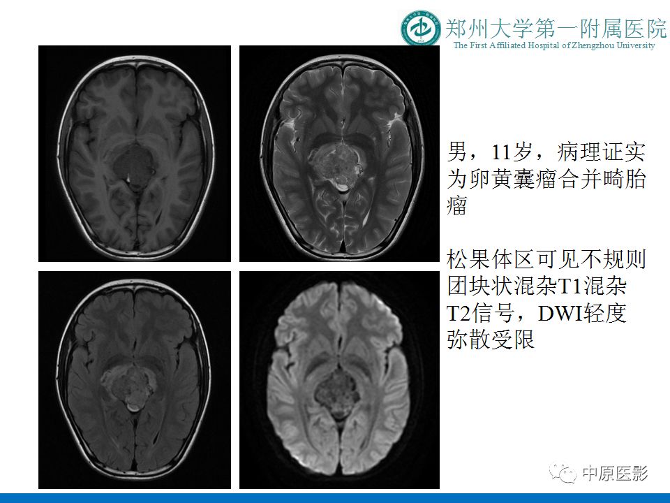 【PPT】松果体区肿瘤的MRI影像分析-29