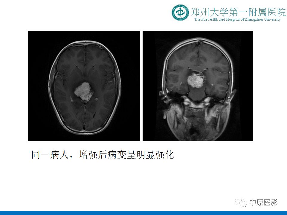 【PPT】松果体区肿瘤的MRI影像分析-30