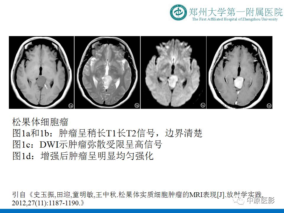 【PPT】松果体区肿瘤的MRI影像分析-34