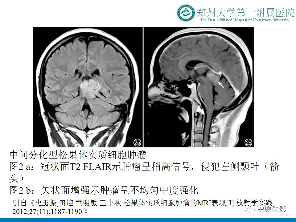 【PPT】松果体区肿瘤的MRI影像分析-37