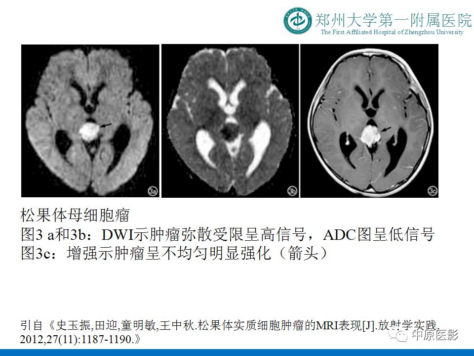 【PPT】松果体区肿瘤的MRI影像分析-38
