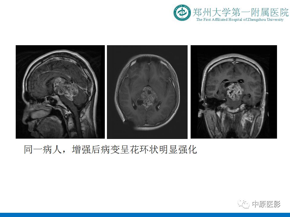 【PPT】松果体区肿瘤的MRI影像分析-41