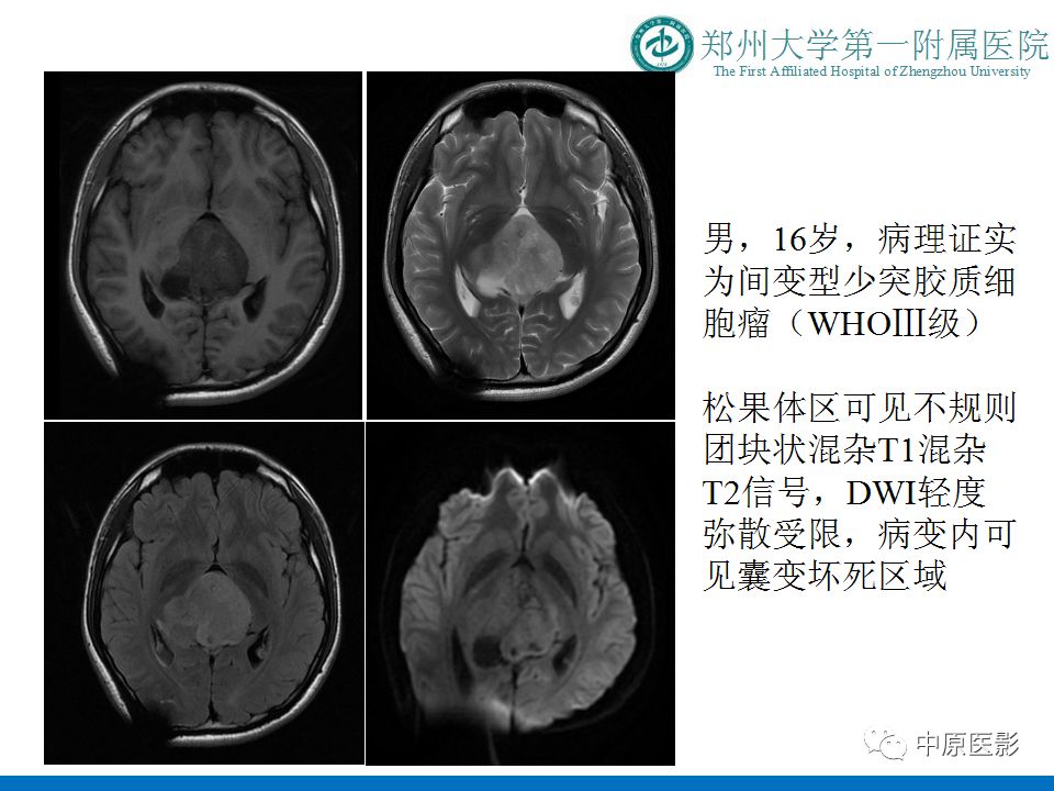 【PPT】松果体区肿瘤的MRI影像分析-40