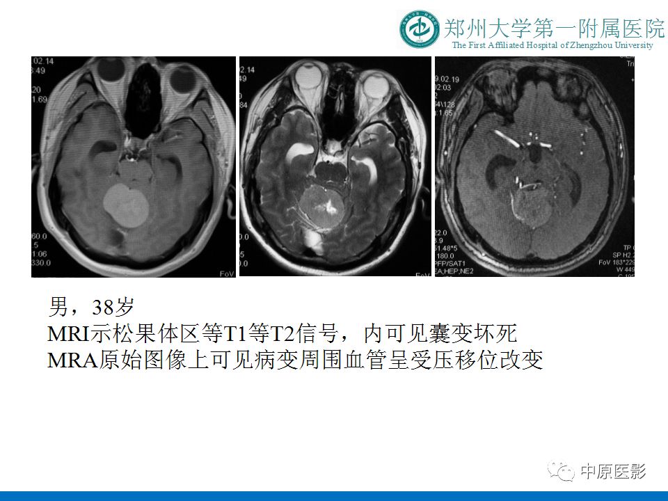 【PPT】松果体区肿瘤的MRI影像分析-43