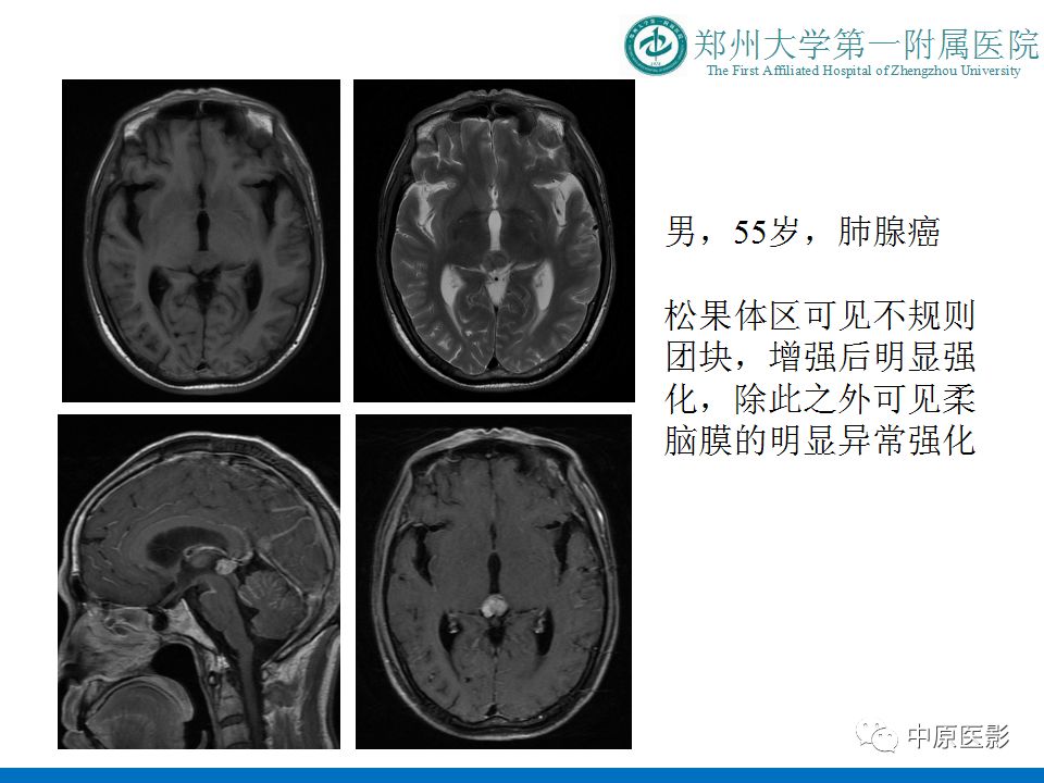 【PPT】松果体区肿瘤的MRI影像分析-46