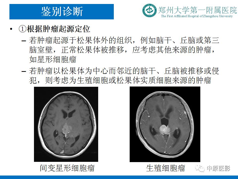 【PPT】松果体区肿瘤的MRI影像分析-47