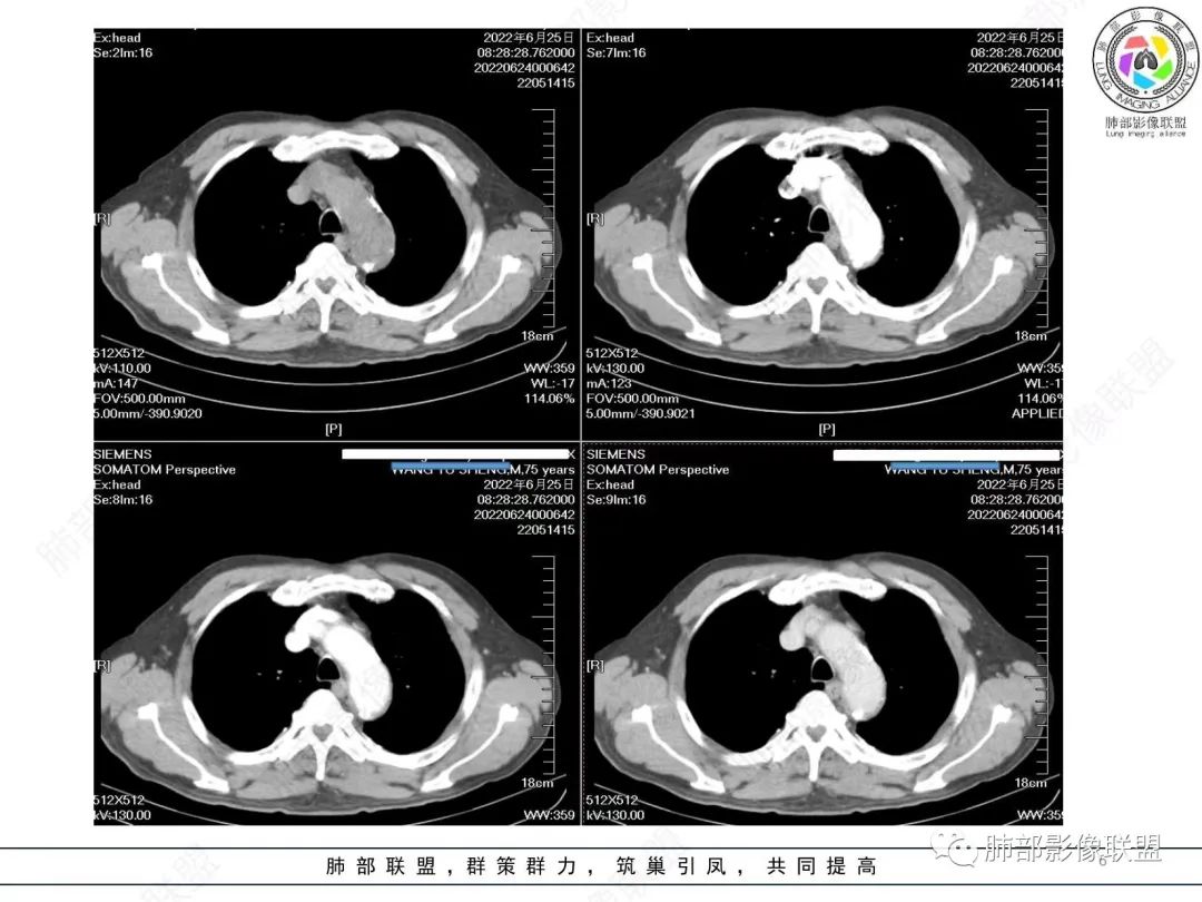 【病例】肺部硕大块影一定想到它！-5