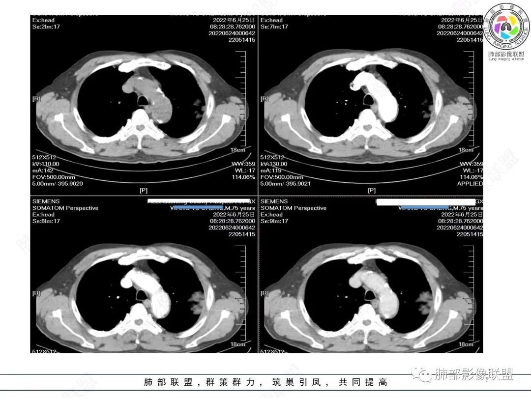 【病例】肺部硕大块影一定想到它！-6
