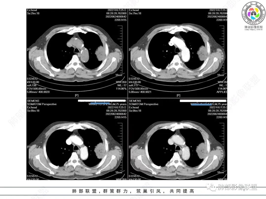 【病例】肺部硕大块影一定想到它！-7