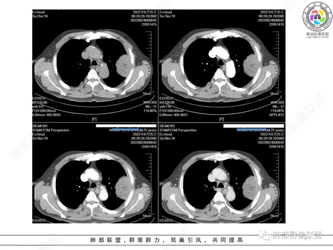 【病例】肺部硕大块影一定想到它！-8