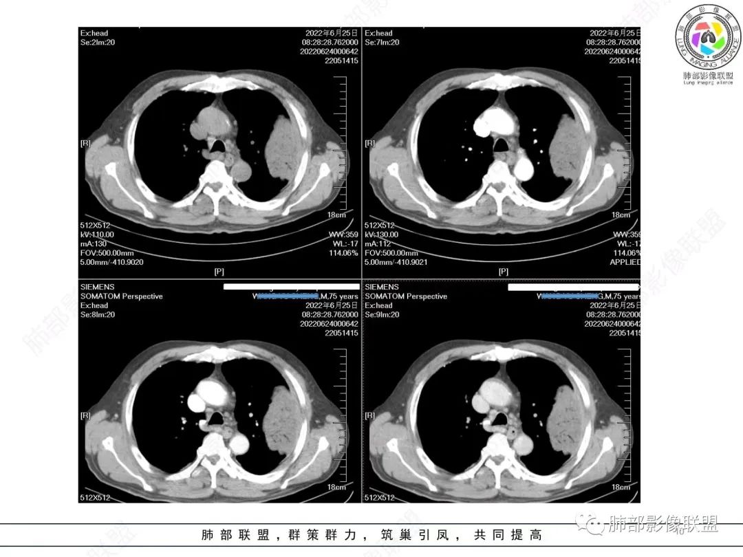 【病例】肺部硕大块影一定想到它！-9
