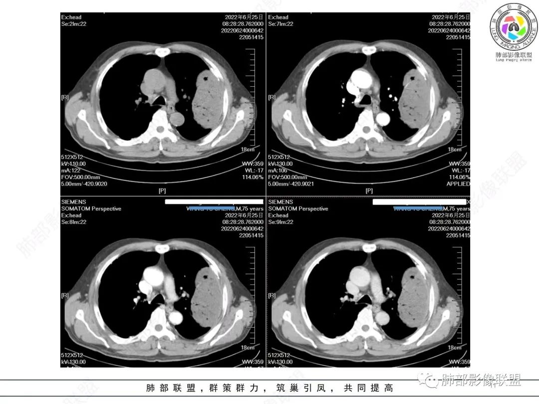 【病例】肺部硕大块影一定想到它！-10