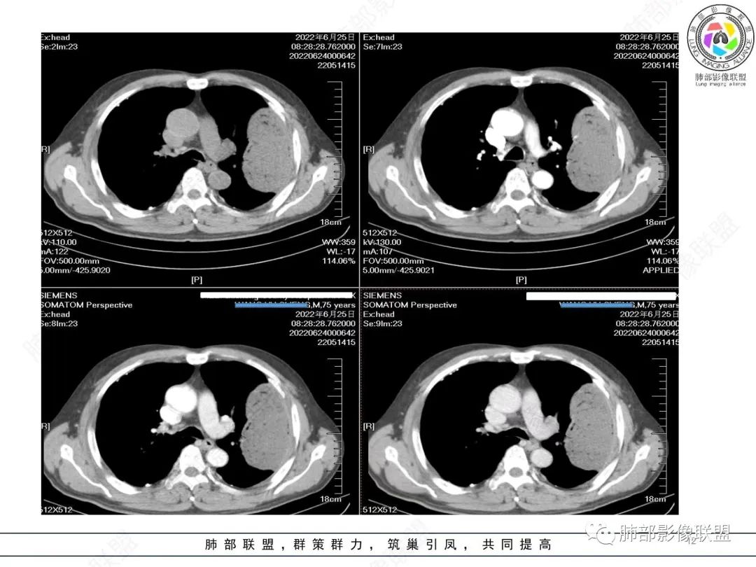 【病例】肺部硕大块影一定想到它！-11