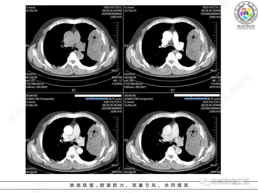 【病例】肺部硕大块影一定想到它！-12