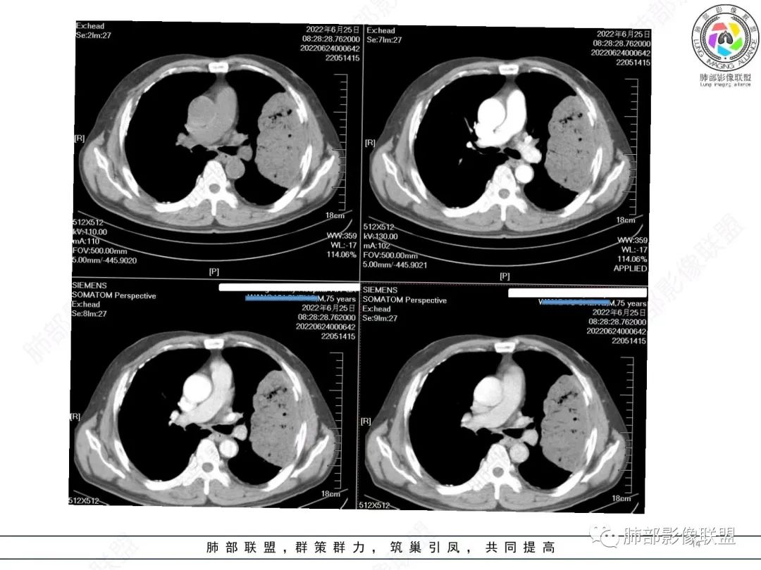 【病例】肺部硕大块影一定想到它！-13