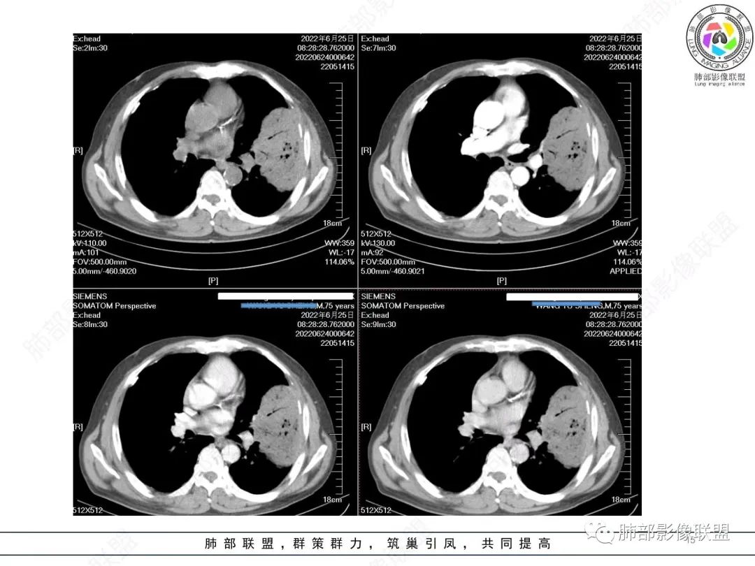 【病例】肺部硕大块影一定想到它！-14
