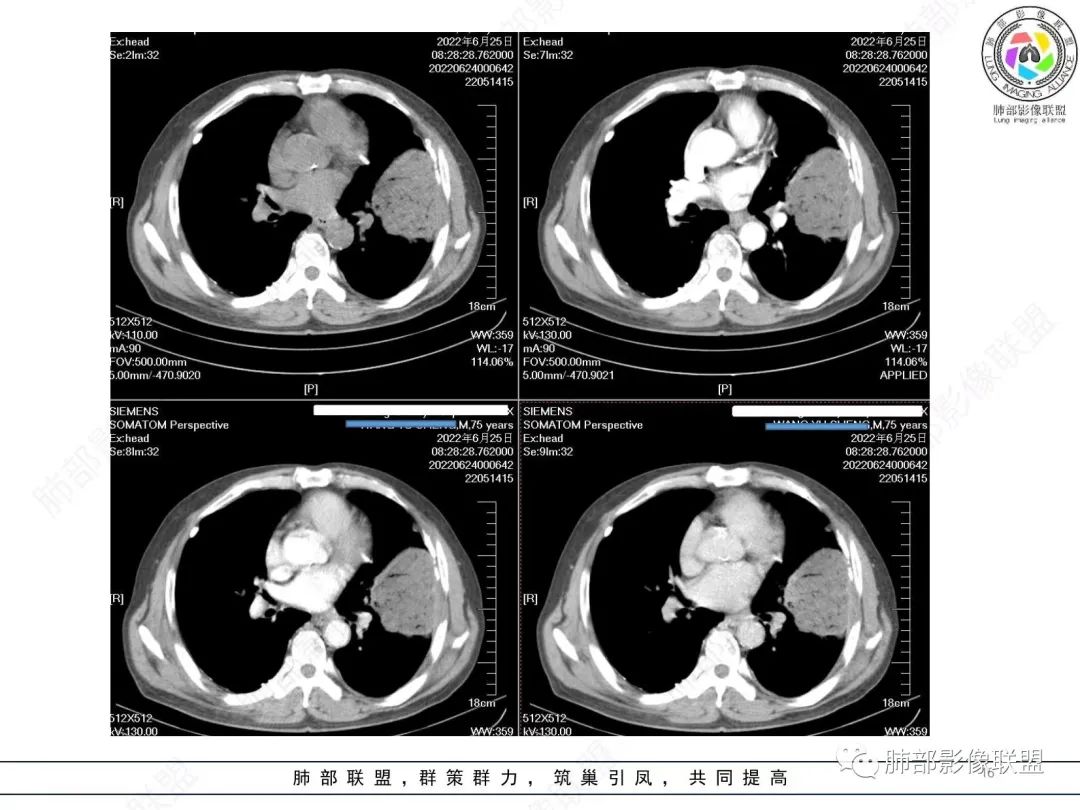 【病例】肺部硕大块影一定想到它！-15