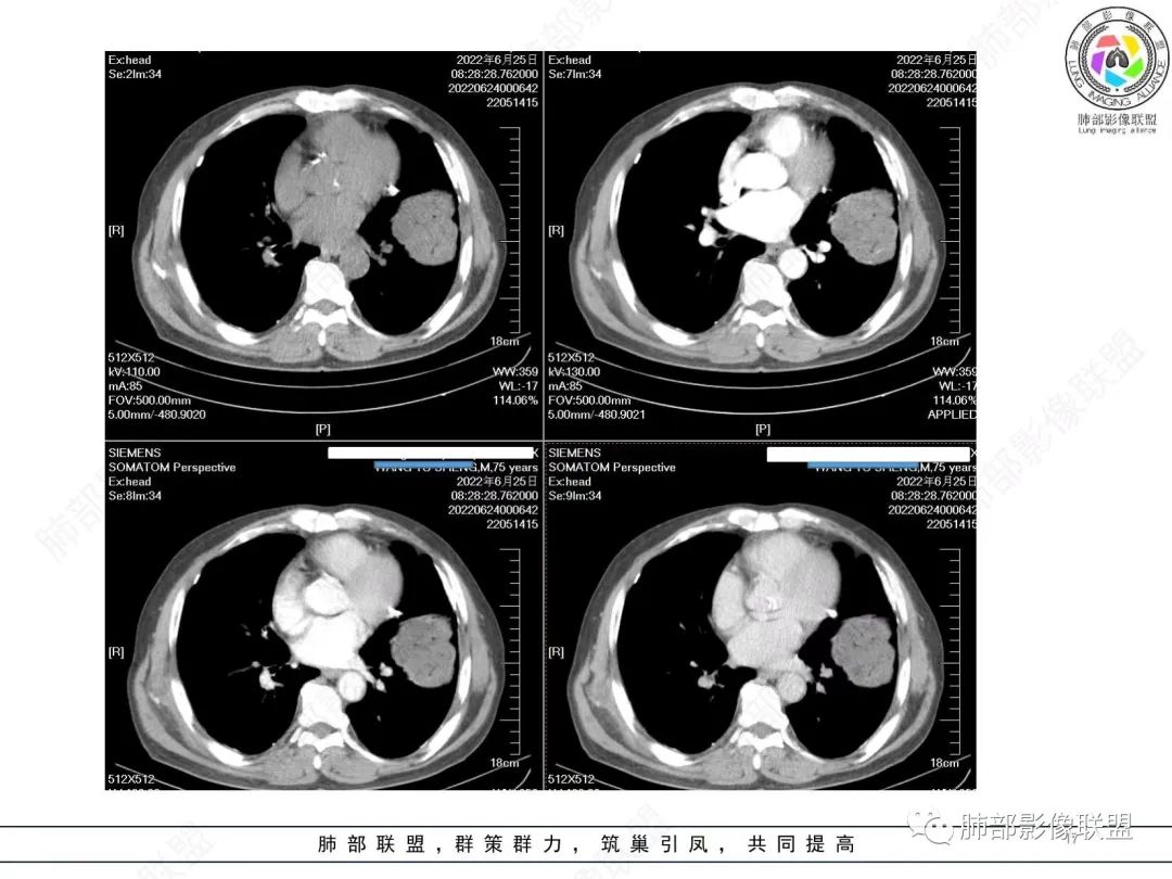 【病例】肺部硕大块影一定想到它！-16