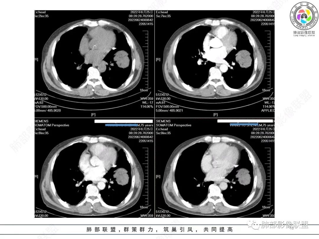 【病例】肺部硕大块影一定想到它！-17