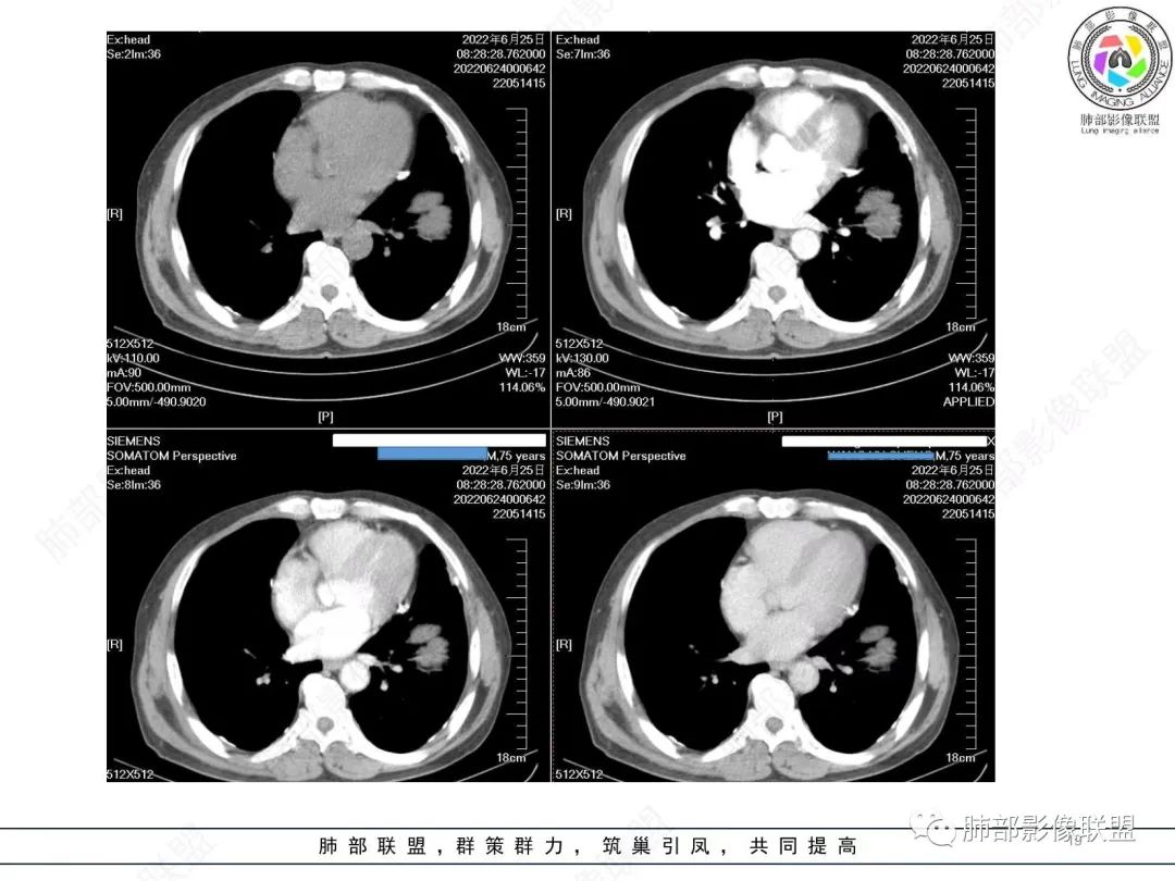 【病例】肺部硕大块影一定想到它！-18