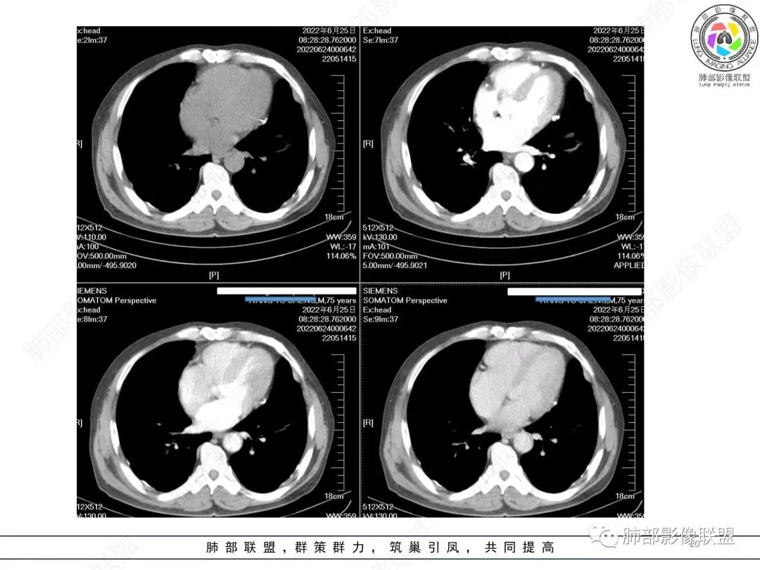 【病例】肺部硕大块影一定想到它！-19