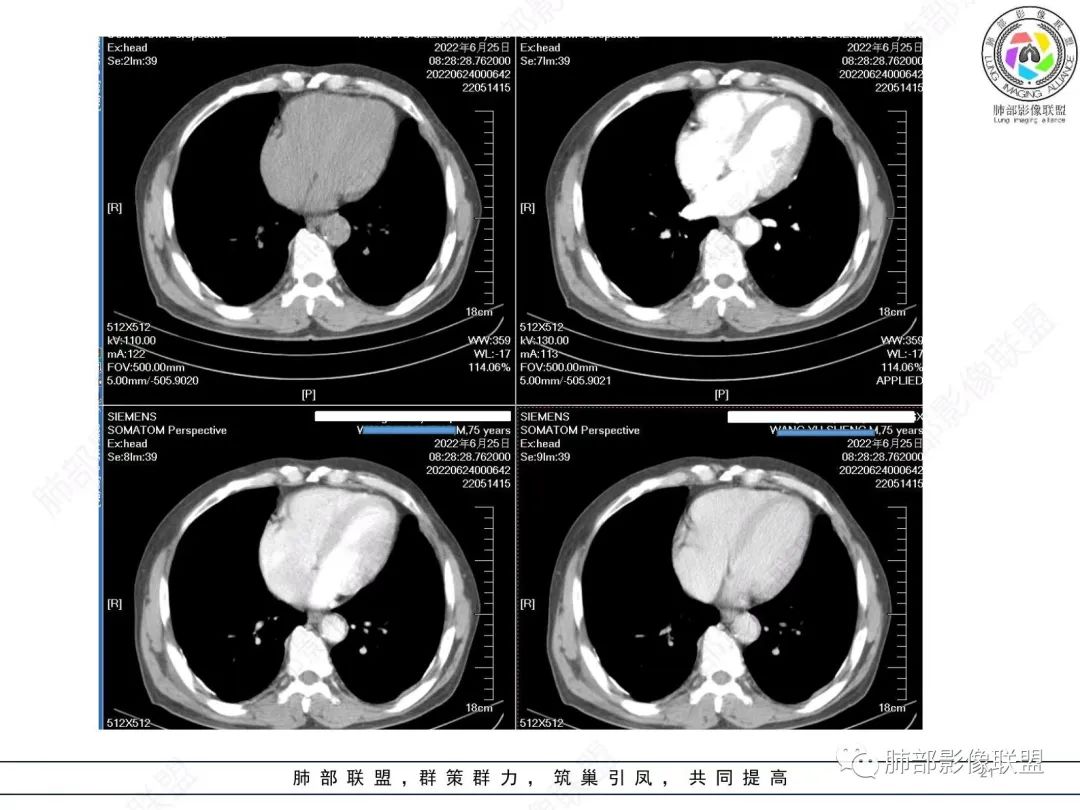 【病例】肺部硕大块影一定想到它！-20