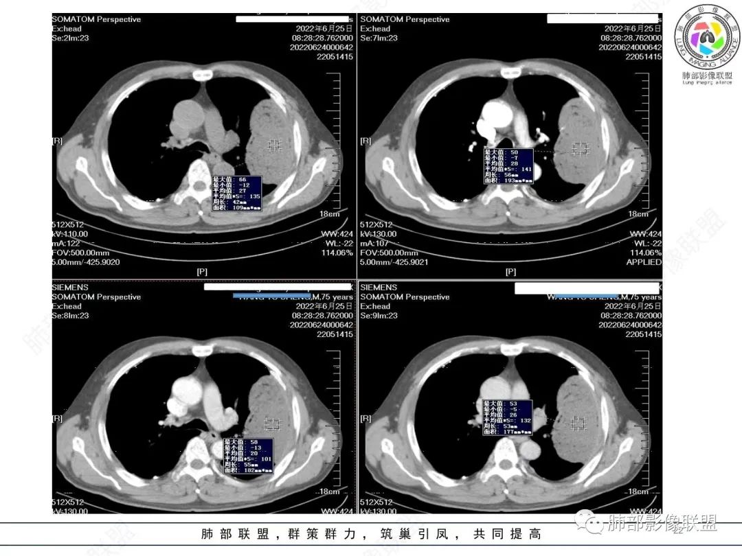 【病例】肺部硕大块影一定想到它！-21
